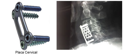 Placa Cervical Dolorespalda.es Dr. Alfredo Charlez