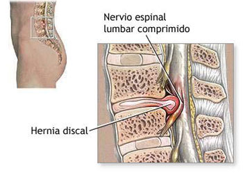 Disco Lumbar Herniado Dr. Alfredo Charlez