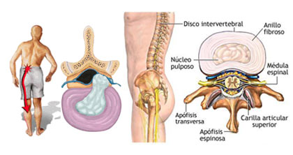 Hernia Discal Traumatologos en Lleida Dr. Alfredo Charlez