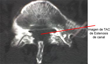Imagen TAC estenosis de canal dolorespalda.es