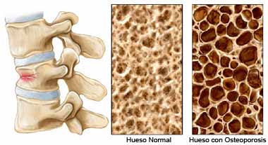 Osteoporosis dolorespalda.es