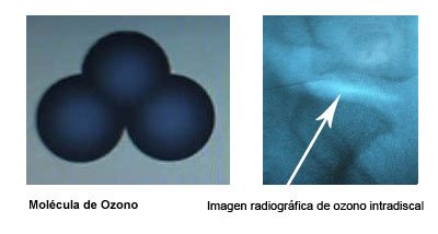 Ozonoterapia dolorespalda.es