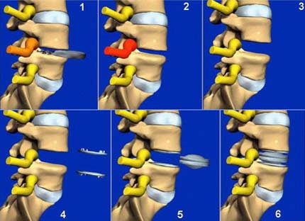 Prótesis lumbar dolorespalda.es