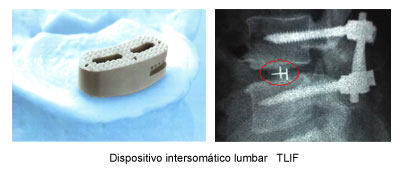Dispositivo intersomático lumbar TLIF