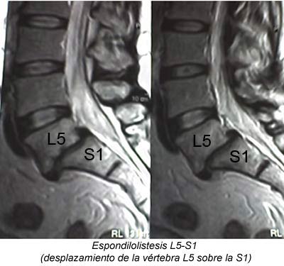 Espondilolistesis L5-S1 (desplazamiento de la vrtebra L5 sobre la S1)